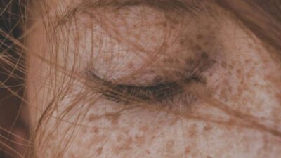 skin-tag-on-eyelid