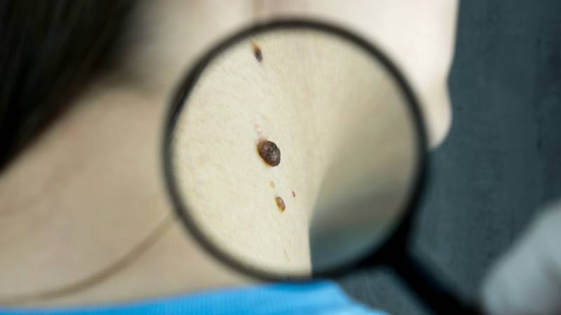 are-skin-tags-contagious