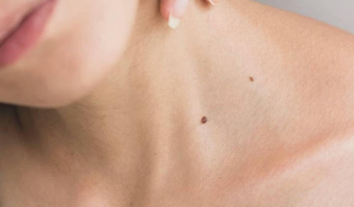 are-skin-tags-contagious