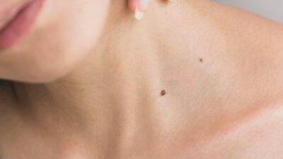 are-skin-tags-contagious