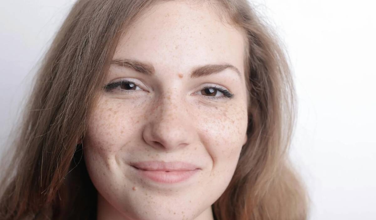 brown-spots-suddenly-appearing-on-skin