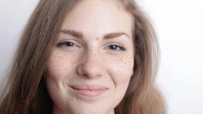 brown-spots-suddenly-appearing-on-skin