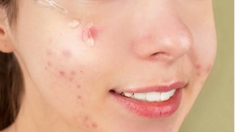 how-to-remove-skin-tags-in-one-night