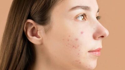 tiny-black-dots-on-skin-suddenly